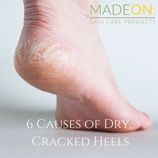 How to heal deep, cracked heels