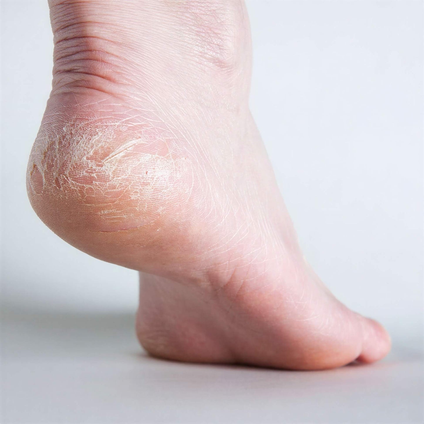 Dry, cracked heel