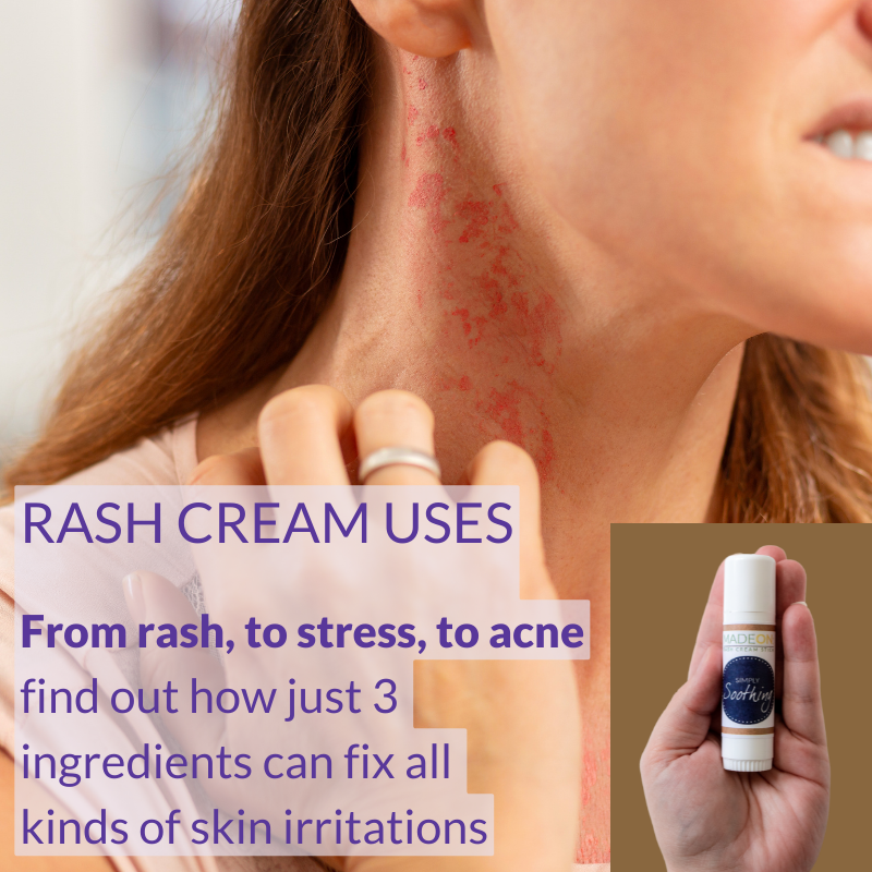 Woman with rash on neck and Simply Soothing Rash Cream text telling it can be used for rash, stress rash or acne