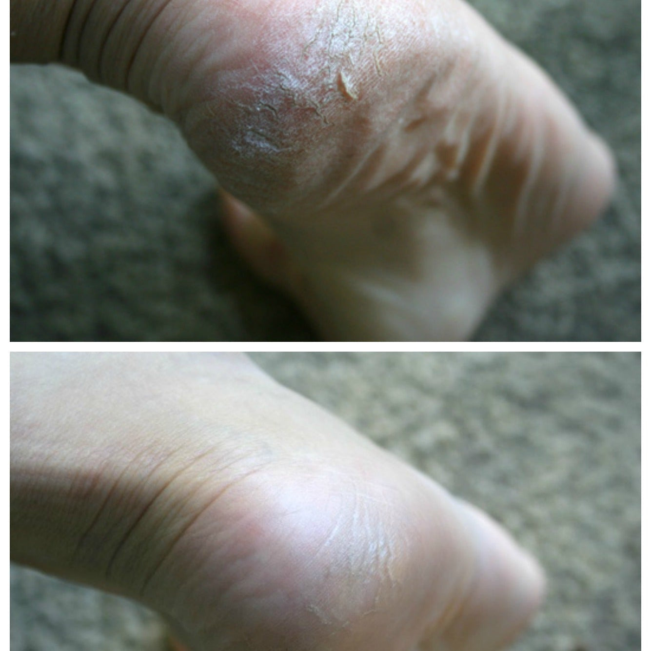 Mini Foot Care Kit