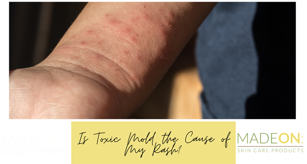 Black Mold Skin Rash