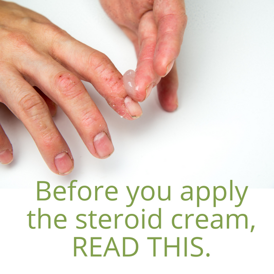 Don't use topical steroids for eczema until you read this story.